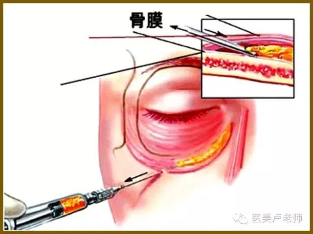 【微整】注射填充泪沟七大技巧